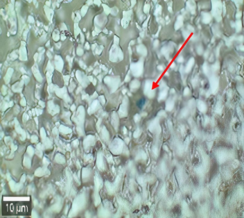 Microplásticos só podem ser vistos por meio de microscópios. Na foto, ponto azul indica microplástico detectado em tecido pulmonar humano.
